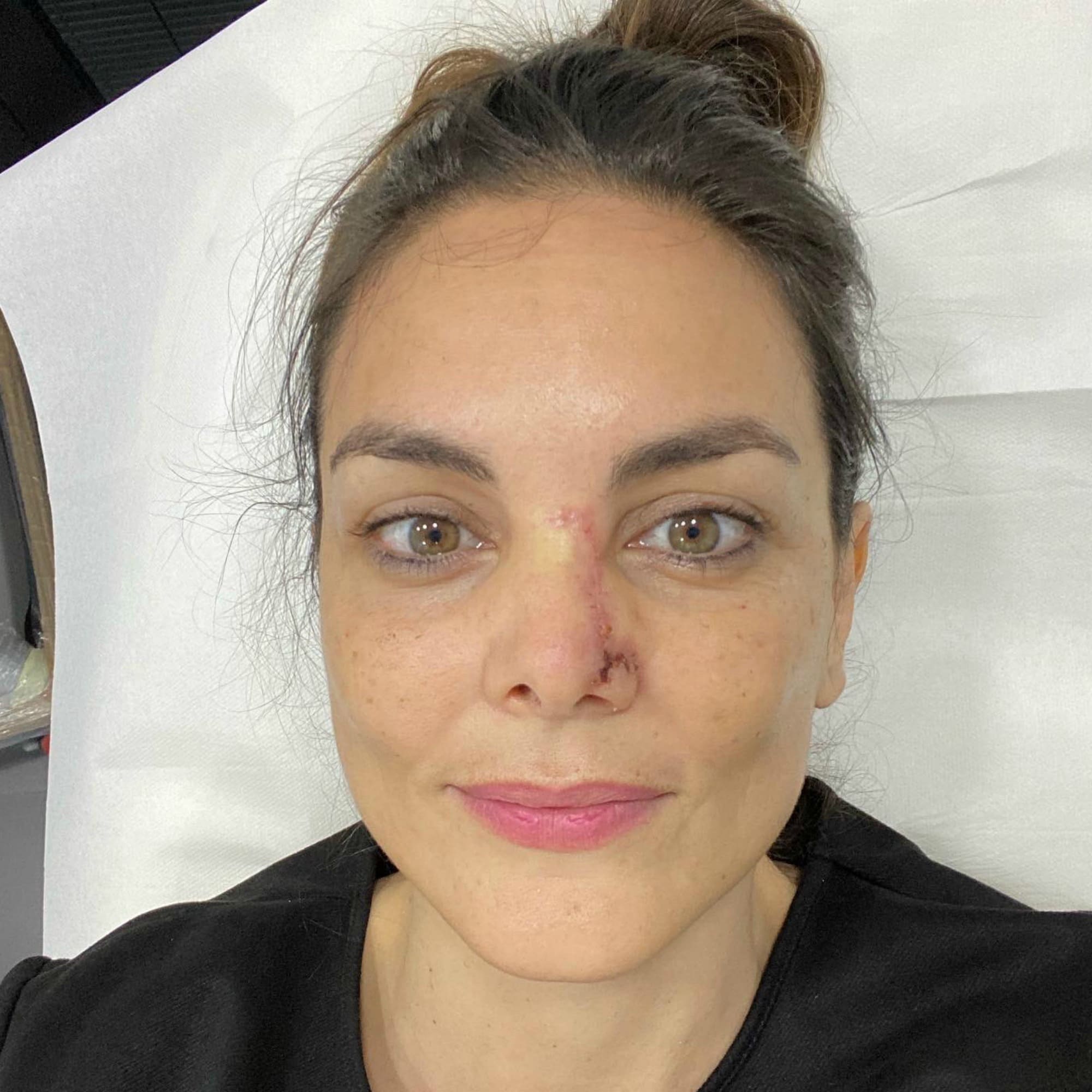 Mónica Carrillo tiene cáncer de piel y así lo ha contado (y mostrado)